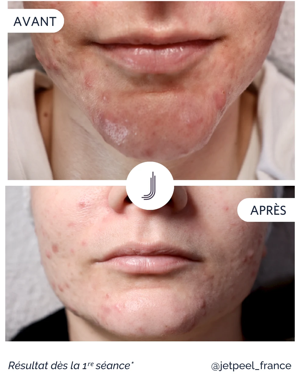 Soins du visage Jet Peel Fréjus